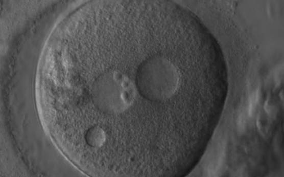 <p><strong>Figure 184</strong></p><p>A zygote generated by ICSI showing what looks like two distinct PNs with distinct membranes and the absence of NPBs in one of the PNs (400× magnification). One small vacuole is visible under the left PN. Two highly fragmented polar bodies are present at 9 o'clock. Despite the presence of 2 polar bodies after ICSI, it is possible that this is a 1PN zygote, and that the structure to the right is a vacuole (compare with Fig. 209). It was not transferred.</p>