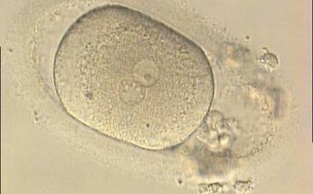 <p><strong>Figure 186</strong></p><p>Oval-shaped zygote generated by ICSI, showing a single NPB in one of the two PNs (‘bull's eye’) and small, scattered NPBs in the other (200× magnification). The PVS is quite large and the polar bodies are highly fragmented. It was discarded.</p>