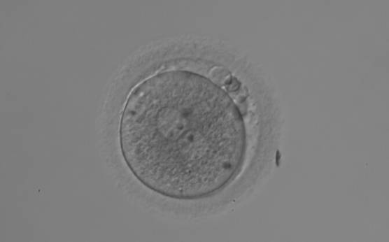<p><strong>Figure 195</strong></p><p>A zygote generated by ICSI displaying heterogeneous, granular cytoplasm (200× magnification). NPBs are large-sized and polar bodies are fragmented. It was discarded due to poor subsequent development.</p>
