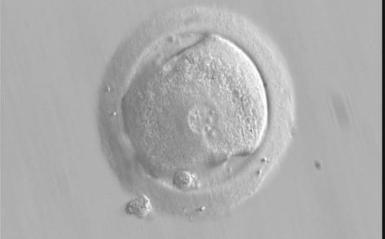 <p><strong>Figure 196</strong></p><p>A zygote generated by IVF using frozen/thawed ejaculated sperm and observed at 17 h post-insemination showing an irregular oolemma and dysmorphic granular cytoplasm (400× magnification). PNs are different in size and peripherally located. NPBs differ in size and number between PNs. It was transferred but failed to implant.</p>