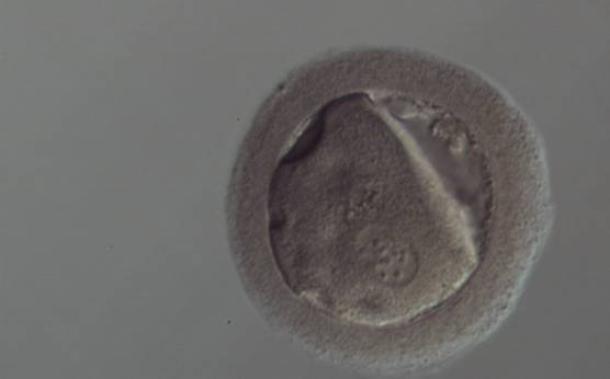 <p><strong>Figure 197</strong></p><p>A zygote generated by ICSI with peripheral PNs (150× magnification). The oolemma is irregular and the cytoplasm is dysmorphic and granular. The ZP is thick and dark. It was discarded.</p>