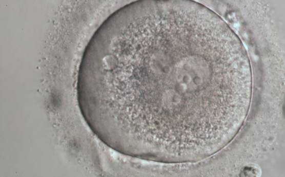<p><strong>Figure 199</strong></p><p>A zygote generated by ICSI with four PNs (possibly a result of fragmentation of an originally normal-sized PN), displaying very granular cytoplasm and a clear cortical zone (600× magnification). It was discarded.</p>
