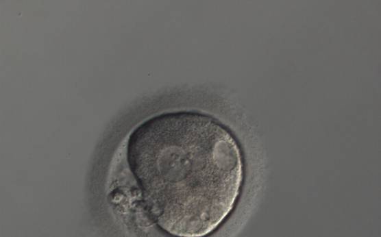 <p><strong>Figure 203</strong></p><p>A zygote generated by ICSI with an irregular oolemma and a large PVS with possibly highly fragmented polar bodies (150× magnification). Different sized overlapping PNs are peripherally positioned and several vacuoles of different sizes are present at the 2, 5 and 6 o'clock position in the cytoplasm. It was discarded.</p>