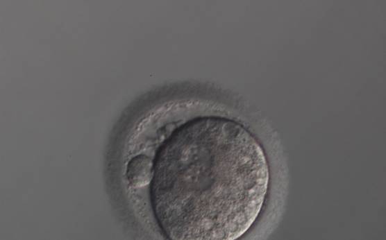 <p><strong>Figure 204</strong></p><p>A zygote generated by ICSI with slightly overlapping peripherally positioned PNs and a large PVS with one large and one fragmented polar body (150× magnification). Many small vacuoles are present throughout the cytoplasm. It was discarded.</p>