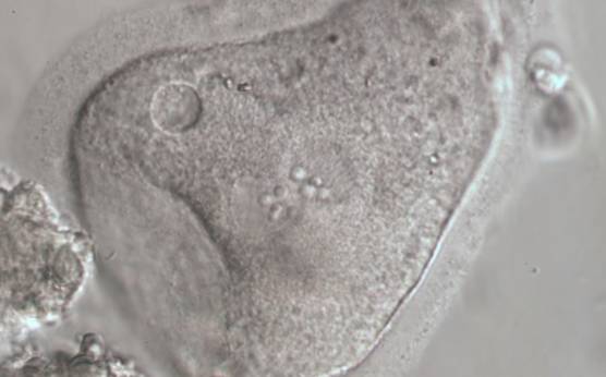 <p><strong>Figure 205</strong></p><p>Severely dysmorphic zygote generated by IVF showing small PNs and an irregularly shaped ZP and oolemma and lack of a PVS (600× magnification). There is a small vacuole present at 10 o'clock with refractile bodies immediately adjacent. It was discarded.</p>