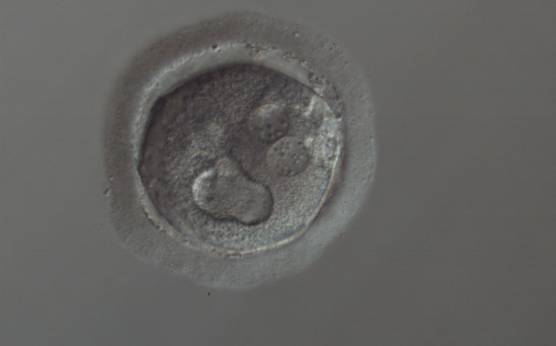 <p><strong>Figure 207</strong></p><p>A zygote generated by ICSI showing cytoplasmic abnormalities (150× magnification). The PNs are juxtaposed and peripherally positioned with a large vacuole of irregular shape at the 6 o'clock position in the cytoplasm. The cytoplasm is granular and the ZP is thick and heterogeneous in appearance. It was discarded.</p>