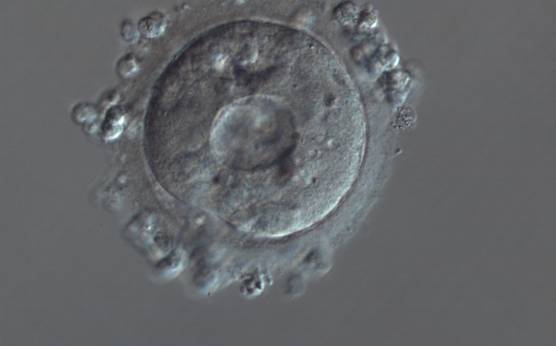 <p><strong>Figure 208</strong></p><p>A zygote generated by ICSI showing severe cytoplasmic abnormalities (150× magnification). There is a large centralized vacuole with many small vacuoles surrounding it in a granular cytoplasm. It was discarded.</p>