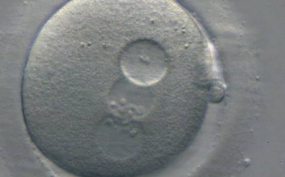 <p><strong>Figure 209</strong></p><p>A zygote generated by ICSI showing peripherally located PNs with the same number and size of NPBs perfectly aligned at the PN junction (400× magnification). There is a large vacuole immediately adjacent to the two PNs that is almost the same size as the PNs. It was discarded.</p>
