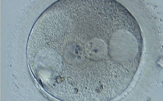 <p><strong>Figure 210</strong></p><p>A zygote generated by ICSI showing centrally positioned PNs and two large vacuoles immediately adjacent to each of the PNs at the 3 and 9 o'clock positions in the cytoplasm (400× magnification). There are also refractile bodies present at the 6–7 o'clock positions and an area of clustering at 11 o'clock. It was discarded.</p>