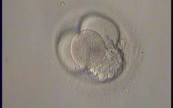 <p><strong>Figure 229</strong></p><p>A 4-cell embryo with 15–20% concentrated fragmentation, evenly sized blastomeres and no visible nuclei. It was generated by ICSI, transferred and implanted.</p>