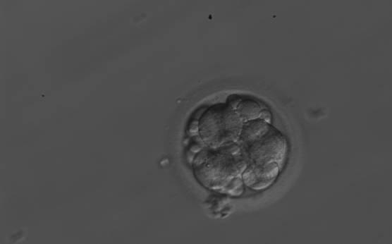 <p><strong>Figure 236</strong></p><p>A 7-cell embryo with 30% fragmentation. Fragments are scattered in the PVS. It was generated by ICSI but was not transferred.</p>