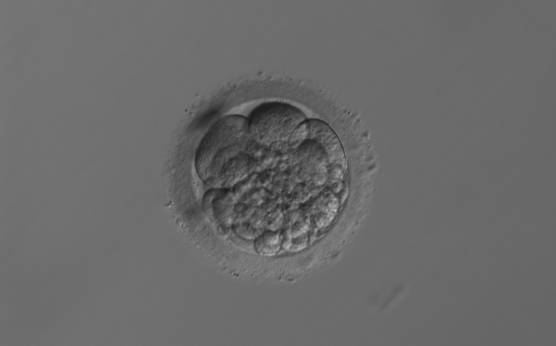 <p><strong>Figure 237</strong></p><p>A 6-cell embryo with 30–40% fragmentation and unevenly sized blastomeres. Fragments are predominantly concentrated in one area. It was generated by ICSI but was not transferred.</p>