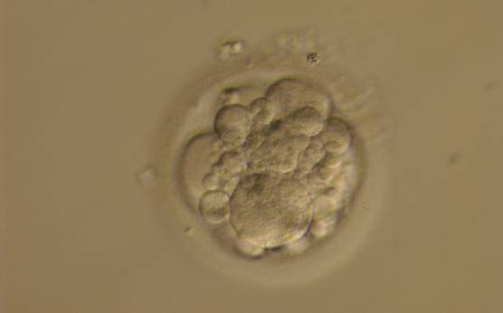 <p><strong>Figure 239</strong></p><p>A 4-cell embryo with around 40% fragmentation which is scattered throughout the embryo. The blastomeres are unevenly sized. It was generated by ICSI but was not transferred.</p>