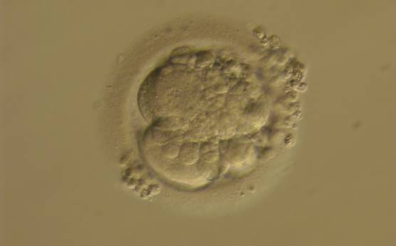 <p><strong>Figure 240</strong></p><p>A 3-cell embryo with around 40% scattered fragmentation and unevenly sized blastomeres. It was generated by ICSI but was not transferred.</p>