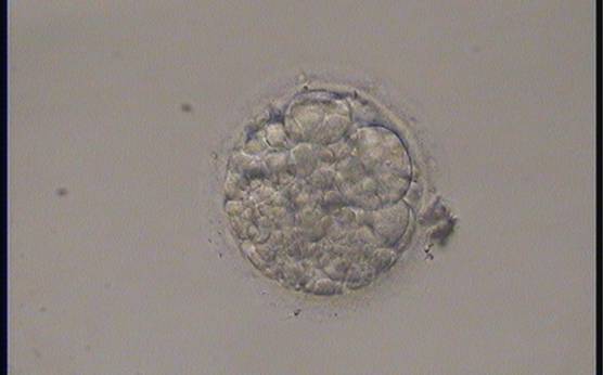 <p><strong>Figure 241 (b)</strong></p><p>In the other two focal planes only one to two cells can be seen (b and c). The embryo was generated by ICSI but was not transferred.</p>