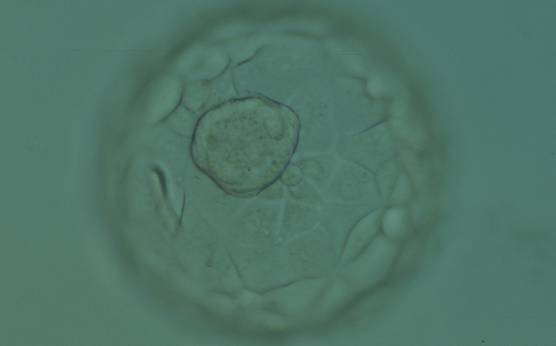 <p><strong>Figure 323</strong></p><p>Expanded blastocyst (Grade 4:1:1) showing a large ICM at the base of the blastocyst in this view. The ICM is made up of many cells that are tightly compacted. The blastocyst volume is now larger than the original volume of the embryo causing the ZP to thin. The blastocyst was transferred but the outcome is unknown.</p>