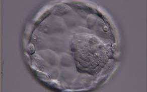 <p><strong>Figure 324</strong></p><p>Expanded blastocyst (Grade 4:1:1) showing a large ICM at the 4 o′clock position in this view. The ICM is made up of many cells and is very compact. The blastocoel cavity is now larger than the original volume of the embryo and the ZP is very thin. The blastocyst was transferred but the outcome is unknown.</p>