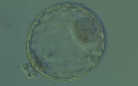 <p><strong>Figure 330</strong></p><p>Hatching blastocyst (Grade 5:1:1) showing a large, compact ICM at the 2 o'clock position in this view. There are many TE cells of equivalent size lining the blastocoel cavity and several TE cells are herniating through a breach in the thinned ZP at the 8 o'clock position in this view. The blastocyst was transferred and implanted.</p>