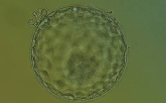<p><strong>Figure 331</strong></p><p>Hatching blastocyst (Grade 5:1:1) showing a large, compact ICM at the base of the blastocyst toward the 5 o'clock position and slightly out of focus in this view. There are very many TE cells of equivalent size making up a cohesive epithelium. Several TE cells have herniated out through a breach in the ZP at the 11 o'clock position in this view. The blastocyst was transferred and implanted.</p>