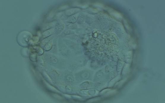 <p><strong>Figure 332</strong></p><p>Hatching blastocyst (Grade 5:1:1) showing a large, compact and slightly granular ICM toward the 3 o'clock position in this view. There are very many TE cells of varying sizes making up a cohesive epithelium with several cells herniating out through a breach in the ZP at the 9 o'clock position in this view. The blastocyst was transferred but the outcome is unknown.</p>