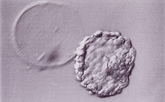 <p><strong>Figure 337</strong></p><p>Hatched blastocyst (Grade 6:1:1) that is now completely free of the ZP which can be seen in the same view. The breach in the ZP is large. The ICM and TE both have many cells and the blastocyst has collapsed slightly and appears more dense. The blastocyst was transferred but the outcome is unknown.</p>