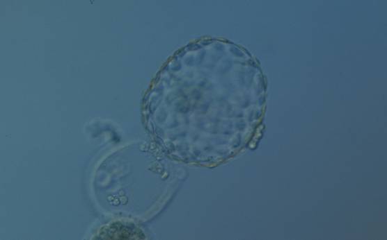 <p><strong>Figure 338</strong></p><p>Hatched blastocyst (Grade 6:1:1) that is now only just free of the ZP which can also be seen in the low magnification view. The ICM is slightly out of focus in this view and is made up of many cells. The TE is similarly made up of many cells forming a cohesive epithelium. There is some cellular debris discarded in the ZP. The blastocyst was transferred but the outcome is unknown.</p>