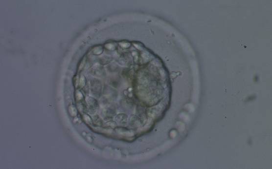 <p><strong>Figure 340</strong></p><p>Collapsed blastocyst, which judging from the thickness of the ZP, is at least a Grade 3. In this view the ICM is clearly discernible at the 3 o'clock position and appears to be of Grade 1 quality. Similarly what can be seen of the TE cells appears to be Grade 1 in quality. There is some extraembryonic cellular debris in the PVS. The blastocyst was transferred but failed to implant.</p>