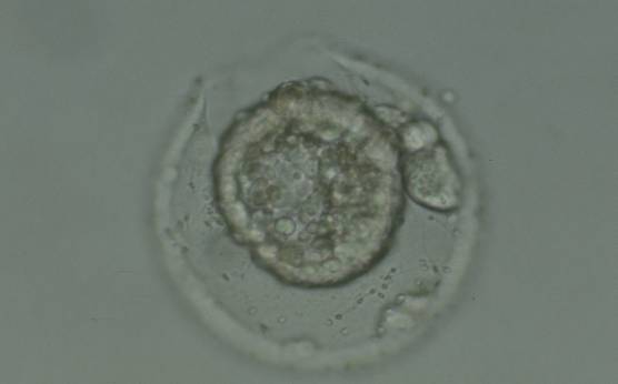 <p><strong>Figure 341</strong></p><p>Collapsed hatching blastocyst (Grade 5) with the hatching site clearly visible as a breach in the ZP at the 11 o'clock position in this view. There is extraembryonic cellular debris both within the blastocoel cavity and external to the blastocyst in the PVS. Both the ICM and TE cannot be properly evaluated. The blastocyst was transferred but failed to implant.</p>