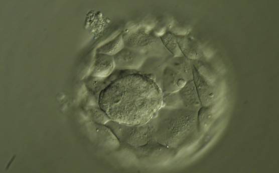 <p><strong>Figure 345</strong></p><p>Hatching blastocyst (Grade 5:1:1) showing a large ICM at the base of the blastocyst in this view. The ICM is made up of many cells that are tightly compacted. The blastocyst was transferred but the outcome is unknown.</p>