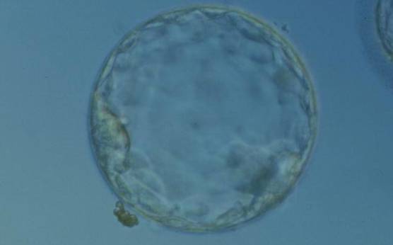 <p><strong>Figure 348</strong></p><p>Hatching blastocyst (Grade 5:2:1) showing a compact ICM at the 8 o′clock position in this view. The ICM is small and flattened and made up of few cells relative to the size of the blastocyst. The blastocyst was transferred but the outcome is unknown.</p>