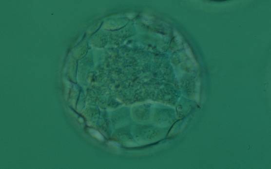 <p><strong>Figure 357</strong></p><p>Expanded blastocyst (Grade 4:1:1) with a large stellate ICM flattened at the base of the blastocyst in this view. The blastocyst was transferred and implanted.</p>