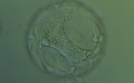 <p><strong>Figure 358</strong></p><p>Hatching blastocyst (Grade 5:1:2) with a large stellate ICM present at the base of the blastocyst in this view. The ICM seems to be connected to the TE cells with short triangular cytoplasmic strings or bridges. The blastocyst was transferred but failed to implant.</p>