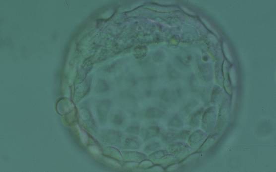 <p><strong>Figure 361</strong></p><p>Hatching blastocyst (Grade 5:1:1) showing a large crescent-shaped ICM at the 12 o'clock position in this view. The blastocyst was transferred and implanted.</p>