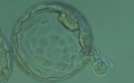 <p><strong>Figure 364</strong></p><p>Hatching blastocyst (Grade 5:1:1) with two separate ICMs that appear to be connected to each other at the 2 o'clock position in this view. One ICM appears to be smaller than the other and is beginning to herniate through a breach in the ZP at the 4 o'clock position along with several TE cells. The blastocyst was transferred and failed to implant.</p>