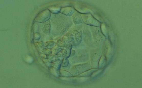 <p><strong>Figure 371</strong></p><p>Hatching blastocyst (Grade 5.1.2). The TE cells vary in size with some cells quite large forming a loosely cohesive epithelium. A stellate ICM can be seen at the 8 o'clock position in this view. The blastocyst was transferred and failed to implant.</p>