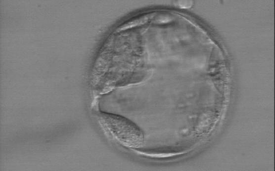 <p><strong>Figure 373</strong></p><p>Early hatching blastocyst (Grade 5:1:3) with a very sparse TE that does not form a cohesive epithelium. The ICM is visible at the 10 o'clock position in this view.</p>