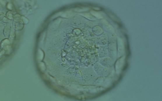 <p><strong>Figure 377</strong></p><p>Expanded blastocyst (Grade 4:1:1). Note several dark granules within the majority of the TE cells. The ICM has several fragments. The blastocyst was transferred but failed to implant.</p>