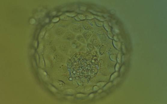 <p><strong>Figure 379</strong></p><p>Hatching blastocyst (Grade 5:1:1) showing many of the TE cells contain dark granules. Several fragments are associated with a centrally positioned, compact ICM. The blastocyst was transferred and implanted.</p>