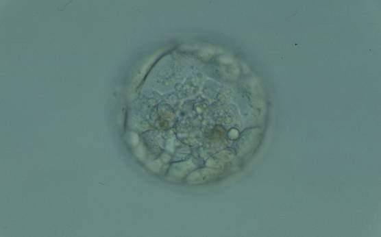 <p><strong>Figure 380</strong></p><p>Blastocyst (Grade 3:1:1) with a compact ICM at the base of the blastocyst that is associated with several granular cellular fragments and two darker foci of cell degeneration. The TE cells appear to be healthy and form a cohesive epithelium. The blastocyst was transferred but failed to implant.</p>