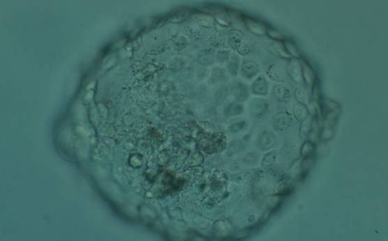 <p><strong>Figure 381</strong></p><p>Hatched blastocyst (Grade 6:1:1) showing many cells in the TE making a cohesive epithelium. Many of the TE cells contain dark granules. The ICM is not clearly seen in this view and there are several degenerative foci (dark cells) associated with the ICM and polar TE. The blastocyst was transferred and implanted.</p>