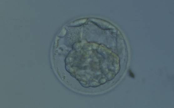 <p><strong>Figure 384</strong></p><p>Hatching blastocyst that has collapsed into a dense mass of cells making it impossible to evaluate the ICM and TE cells. Several cells not participating in blastocyst formation can be seen in the PVS.</p>