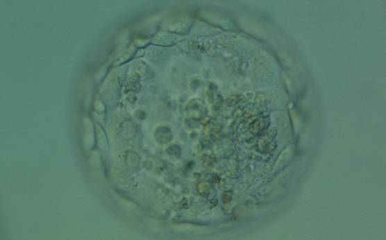 <p><strong>Figure 387</strong></p><p>Expanded blastocyst (Grade 4:1:1) in which the ICM is not clear in this view. The TE cells vary in size but form a cohesive epithelium. There are several small- to medium-sized fragments present inside the blastocoel cavity, some of which are quite dark. The blastocyst was transferred but failed to implant.</p>