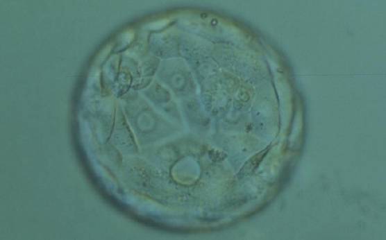 <p><strong>Figure 392</strong></p><p>Expanded blastocyst (Grade 4:3:2) in which a large vacuole can be seen at the 6 o'clock position between TE cells. The blastocyst was transferred but the outcome is unknown.</p>