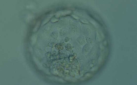 <p><strong>Figure 393</strong></p><p>Hatching blastocyst (Grade 5:1:1) showing a compact ICM at the 6 o'clock position which is associated with several cellular fragments. The TE is made up of many cells that form a cohesive epithelium but there are two medium-sized vacuoles within TE cells abutting the ICM toward the 9 o'clock position. The blastocyst was transferred but failed to implant.</p>