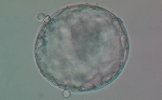 <p><strong>Figure 395</strong></p><p>Early hatching blastocyst (Grade 5:1:1) which is beginning to hatch naturally from two different small breaches in the ZP. The ICM is large and compact and the TE cells are many and form a cohesive epithelium. The blastocyst was transferred but the outcome is unknown.</p>