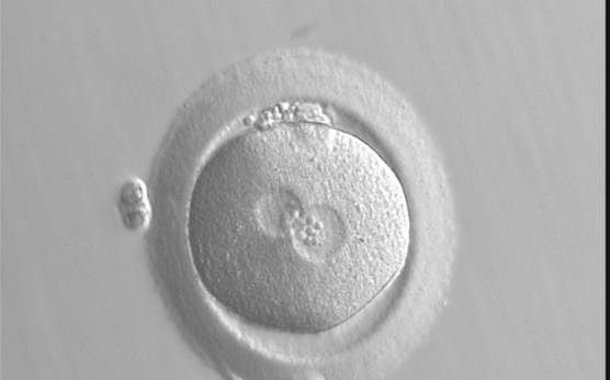 <p><strong>Figure 87</strong></p>

<p>A zygote at 18.5 h generated by standard insemination using frozen/thawed ejaculated sperm (400× magnification). The two PNs are centrally located: one is slightly larger than the other. NPBs are of the same size, but different in number and are aggregated at adjacent borders of each PN. The ZP appears thick. It was transferred but failed to implant.</p>