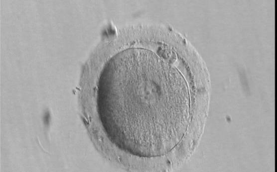 <p><strong>Figure 92</strong></p>

<p>A single, large PN and two polar bodies (partially overlapping) are present in this oocyte observed 16 h and 45 min post-IVF (400× magnification). Four large-sized NPBs are visible. The resulting embryo was transferred, but failed to implant.</p>
