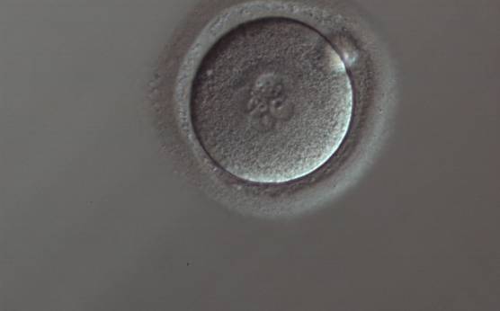 <p><strong>Figure 94</strong></p>

<p>A zygote generated by ICSI displaying four PNs of approximately the same size and two of smaller size (150× magnification). Only one polar body is visible.</p>