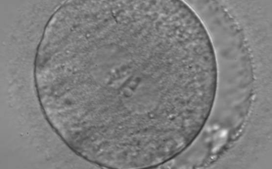 <p><strong>Figure 99</strong></p><p>A zygote observed 18 h post-ICSI (400× magnification). The 2PNs are centrally located and juxtaposed in the cytoplasm (peripherally granular), of approximately the same size, and exhibit inequality in the number and size of NPBs. The PN on the right demonstrates fewer but larger nucleoli. Some debris appears to be present in the slightly increased PVS. Transferred on Day 3 (eight cells) along with two other embryos to a patient who delivered a healthy baby boy.</p>