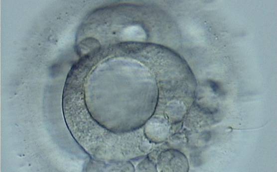 <p><strong>Figure 279</strong></p><p>A 3-cell embryo with a large vacuole in the blastomere in the first plane in this view. A smaller vacuole is present in another blastomere. High fragmentation, about 40%, concentrated in one area.</p>